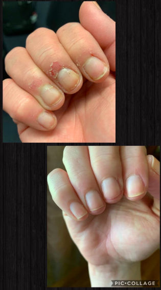 A before and after of a reviewer with damaged cuticles and then smooth cuticles