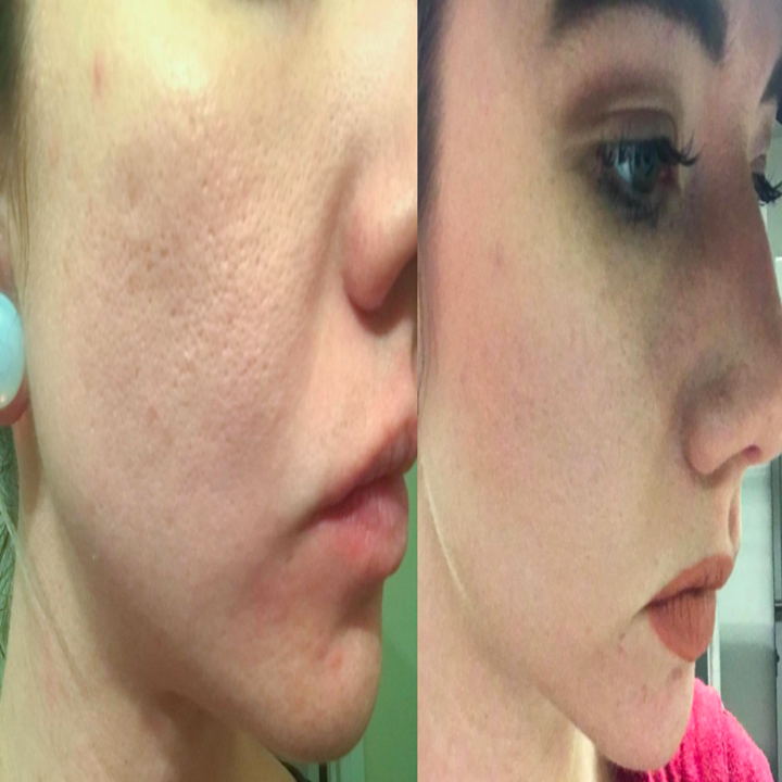 A customer review before and after photo showing the results on their skin