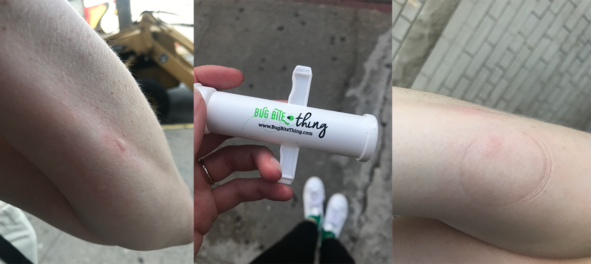 buzzfeed editor&#x27;s mosquito bite / editor holding the suction tool / the mosquito bite looking much less red and swollen after using the tool 