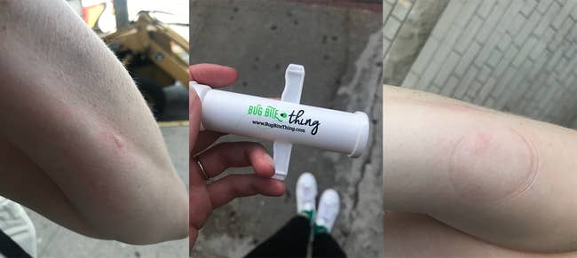 buzzfeed editor's mosquito bite / editor holding the suction tool / the mosquito bite looking much less red and swollen after using the tool 