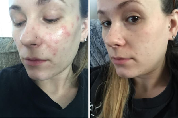 19 Skincare Products With Dramatic Before-And-After Photos