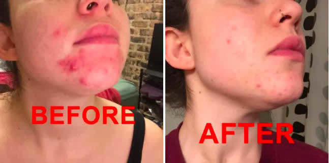 A customer review photo showing their chin before and after using the mask