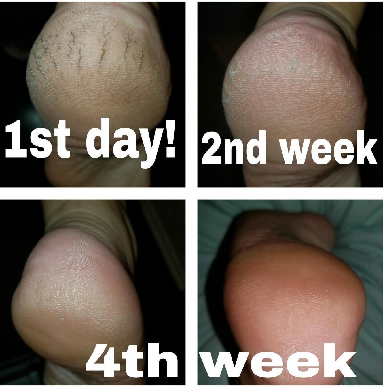 Progression photos showing a reviewer's extremely dry and cracked heals becoming moisturized