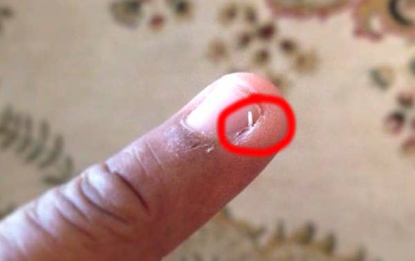 Close-up of a finger with a small splinter lodged under the skin, circled in red for emphasis