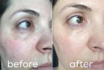 a reviewer showing how red their skin looked before using the product and how clear it looks after