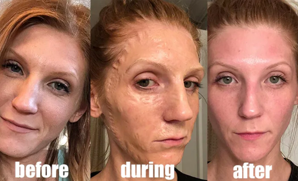 Reviewer showing before, during, and after shots where during their skin looks pulled taught and wrinkly. It looks dewy, clean, and bright after use. 