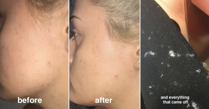 A reviewer&#x27;s before-and-after of showing clumps of dead skin and peach fuzz that was shaved from their face 