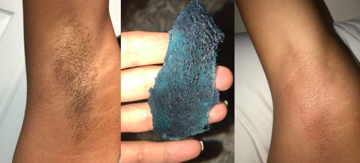 A person with hairy armpits used the wax to remove it all —their armpit is completely bare
