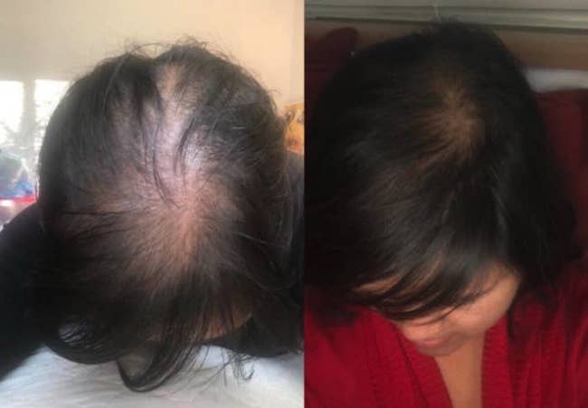 Reviewer's before-and-after of them showing some balding on the top of their head compared to the bald spot being almost completely grown in 