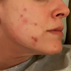 Reviewer's cheeks with dark red acne scars and breakouts