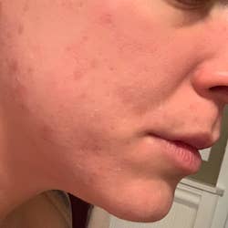 same reviewer's pic of healed breakouts after using patch