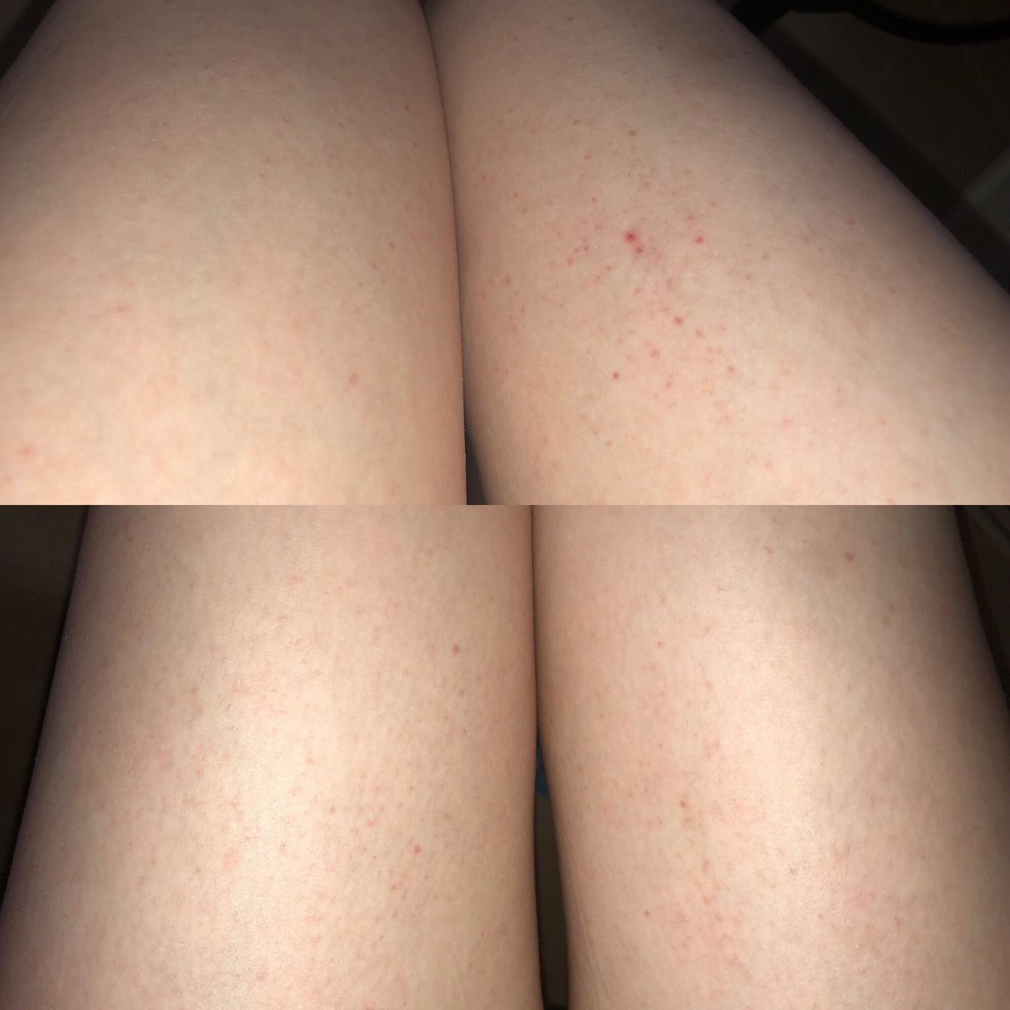 Before and after of reviewer who used the scrub to remove their keratosis pilaris from their legs