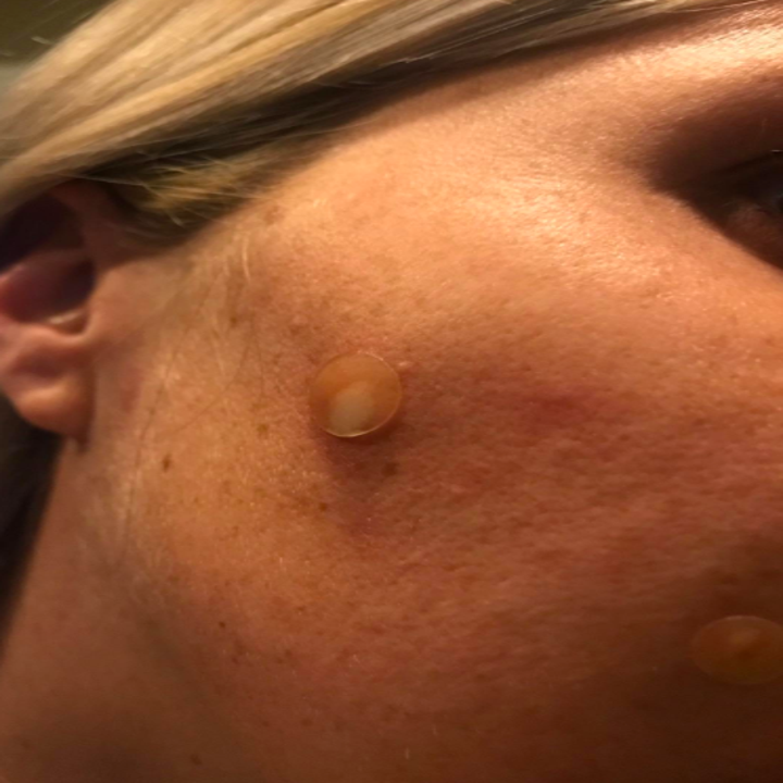 How To Draw Out A Pimple Overnight 7 Home Remedies For Boils