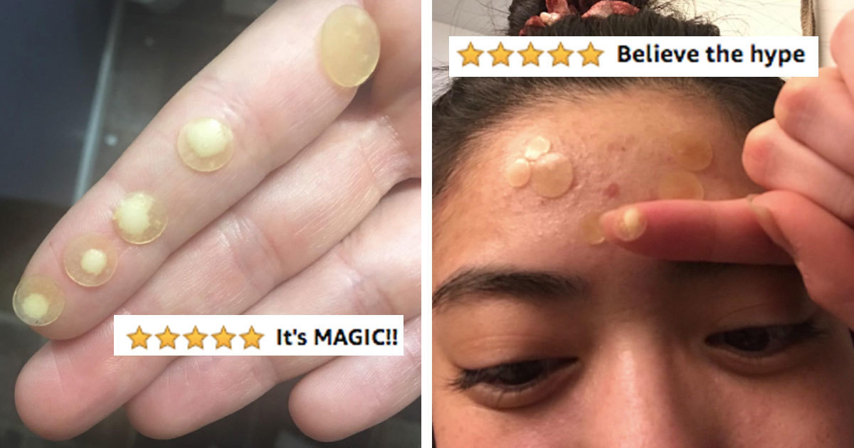 Nexcare Acne Patches Suck All The Goo Out Of Your Zits And It S The Most Satisfying Thing I Ve Ever Seen