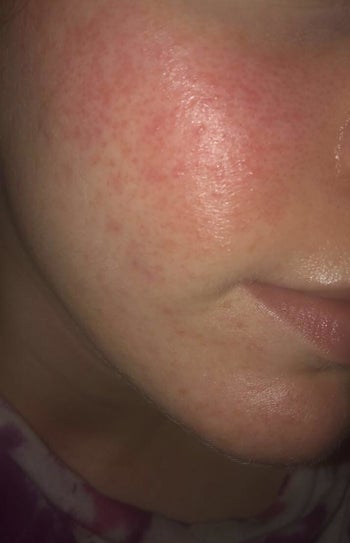 The same cheek with lessened inflammation.