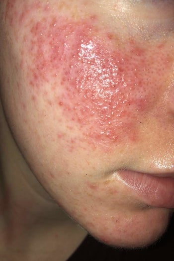 before using paula's choice liquid exfoliant