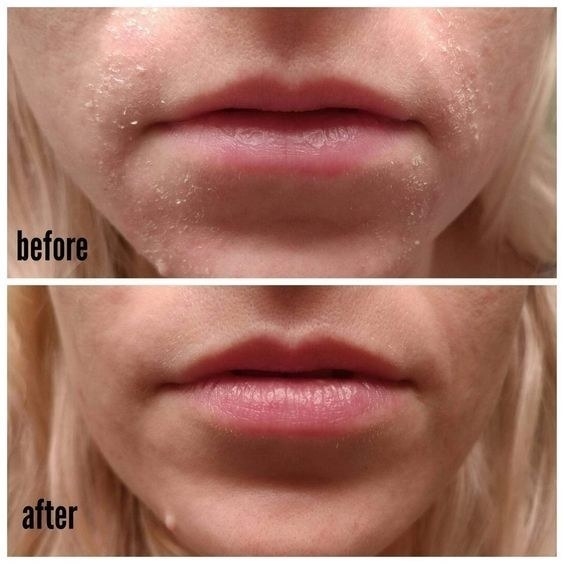A reviewer&#x27;s before/after showing the flaking around their mouth go away