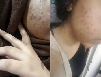 A before-and-after of someone with a lot of acne on their cheek compared to fewer bumps and less redness on the same cheek 