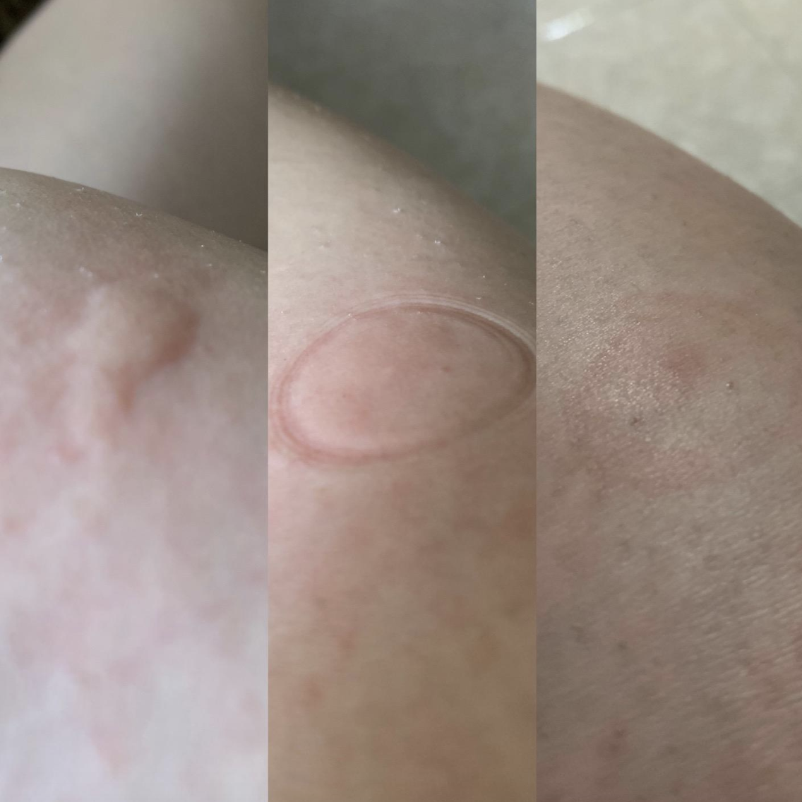Review pic of before, right after, and a little later after using the tool with a bug bite basically disppearing all together