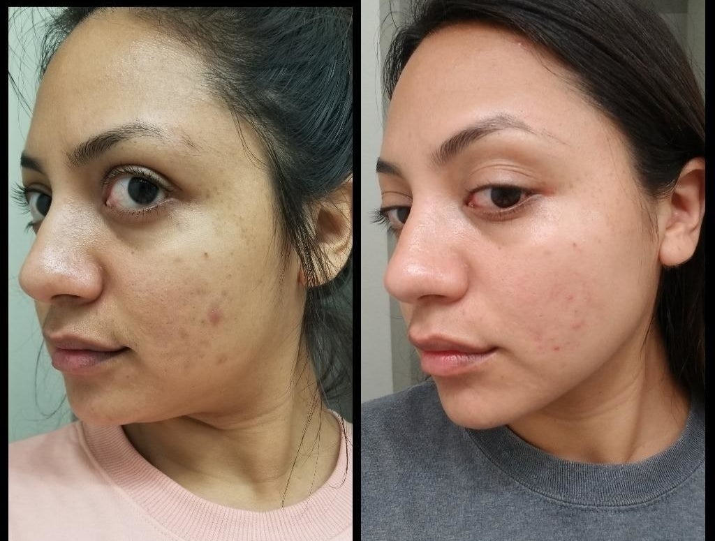 reviewer&#x27;s before-and-after of her face showing some blemishes on her cheek compared to the bumps and marks being about 85% gone