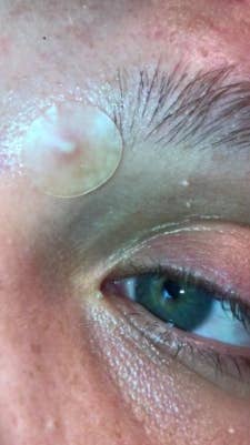review pice of a patch over a pimple near the person's eye