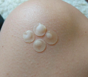 reviewer pic of four used patches with white stuff from the pimples