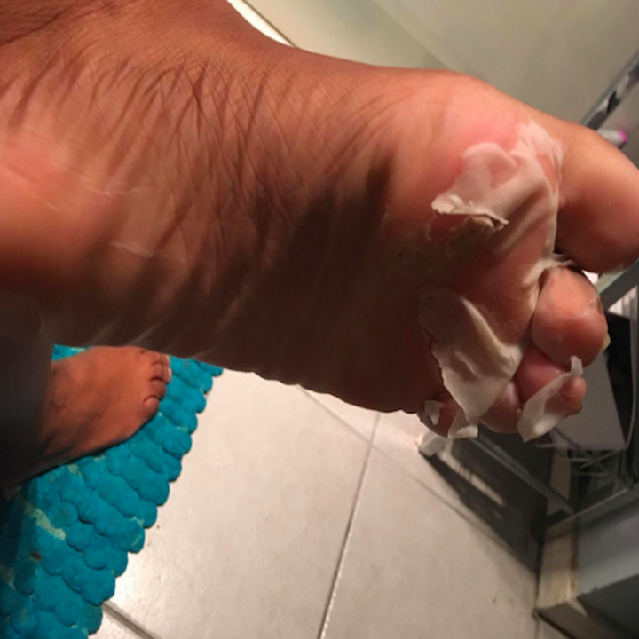 A foot with some of the dead skin peeling off of the top after using the mask.