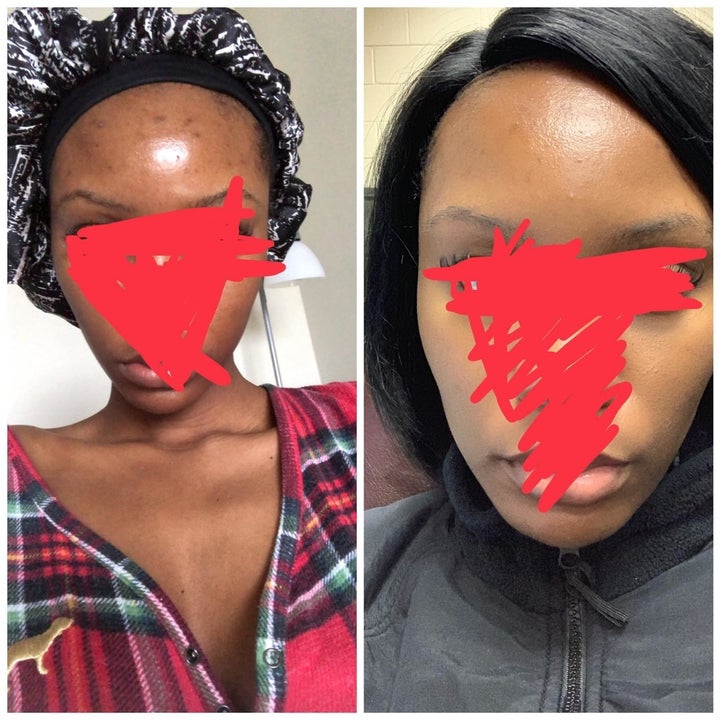 Another reviewer's before and after showing the mask helped even their skin tone and got rid of dark spots on their forehead