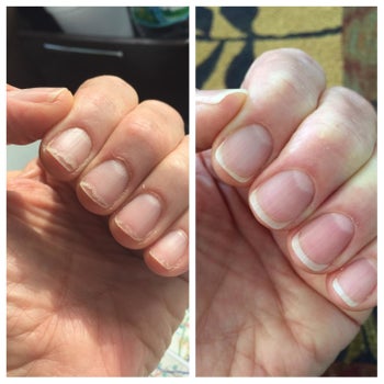 Before and after of reviewer who used the oil, showing that it helped reduce nail breakage