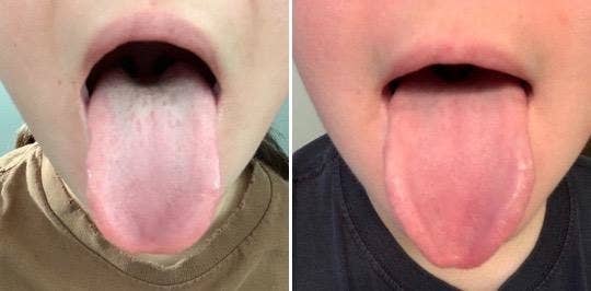 Reviewer before and after showing the scraper removed a brown film that was on their tongue