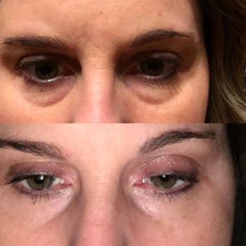 reviewer pic of eyes with bags, then after using these masks with plumper, healthier looking undereyes