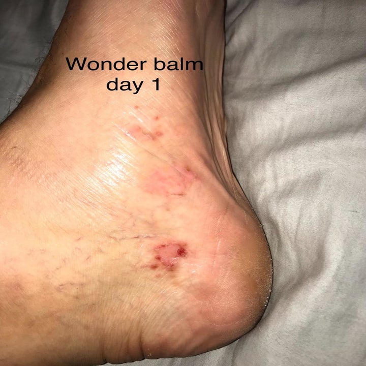 Photo of reviewer's foot after one application 