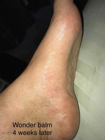 Same reviewer's foot after four weeks of consistent application, which is now completely healed and free of the red rash