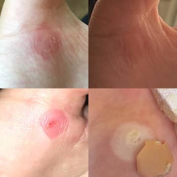Different reviewer's progression showing the pads removed a dime-size wart