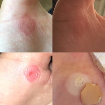Different reviewer's progression photos showing the pads removed a dime-size wart