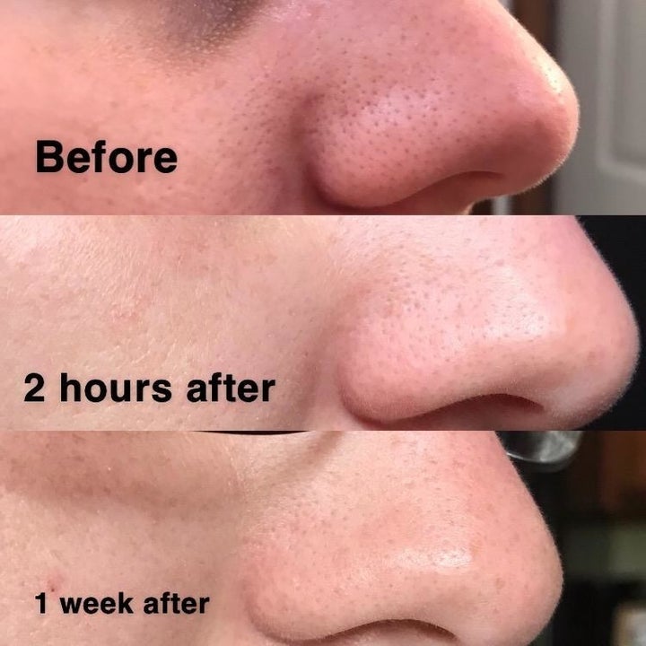 Reviewer progression photo showing the blackhead remover slowly shrinking their pores over a period of days
