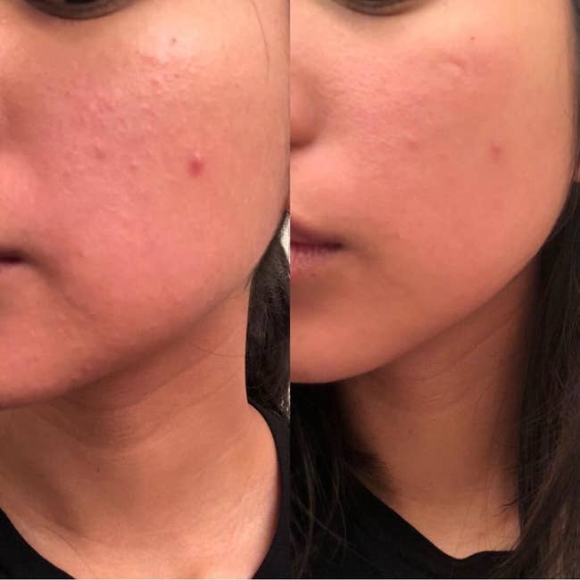 reviewer's skin red and bumpy in before picture, then smoother, calmer, and with diminished pimples in second picture after using product