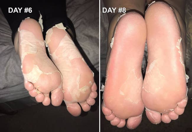 before photo of large chunks of skin peeling from a reviewer's foot six days after applying the foot mask, and then the same feet with most of the skin gone to reveal soft heels after eight days