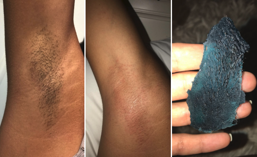 Reviewer image of armpit hair and then an armpit after the wax showing no hair