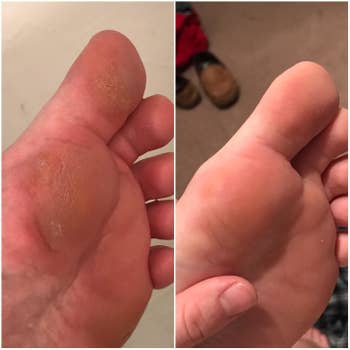 A before photo showing the bottom of a foot looking rough and an after photo showing the bottom of the same foot appearing smoother