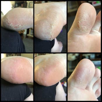 Calluses on a heel and toe looking improved and less rough in reviewer after photos