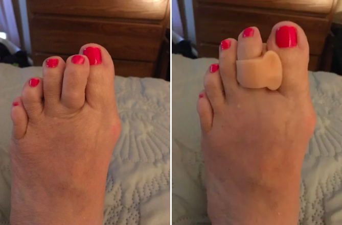 a before and after of a reviewer&#x27;s toe overlapping with their big toe and then the other image shows the toe separator keeping the toes apart 