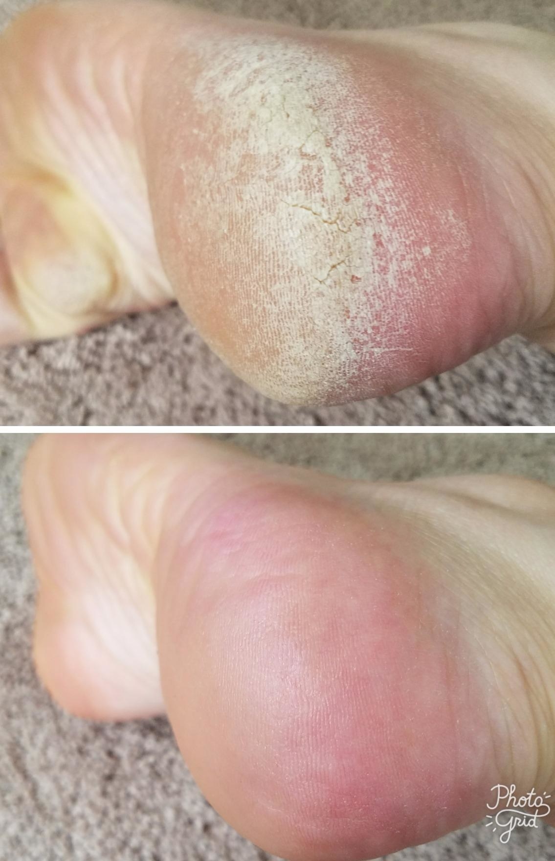 A reviewer&#x27;s before/after of a callused heel and a smooth heel after use