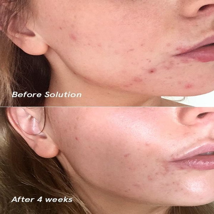 a split vertical image with the top half showing a model with bad acne, the bottom half shows clearer skin after four weeks