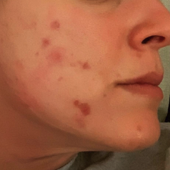 a reviewer's photo of their acne-filled face