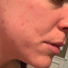 the reviewer's healed face after using the patches