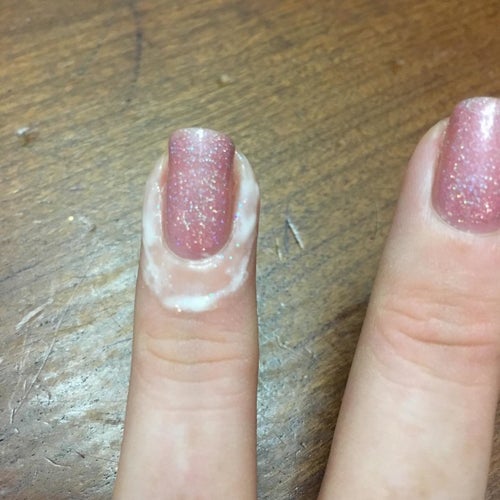 finger with white liquid around nail