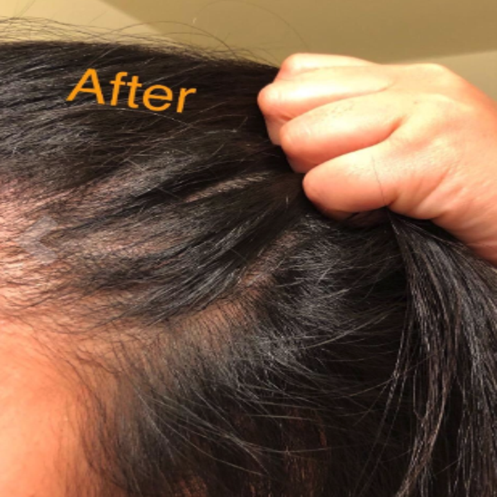 the same reviewer's scalp with clean hair after using the shampoo