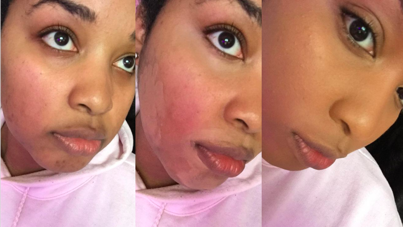 reviewer with bright red inflammation on cheek, then concealer before blended, then the concealer blended looking smooth and perfect