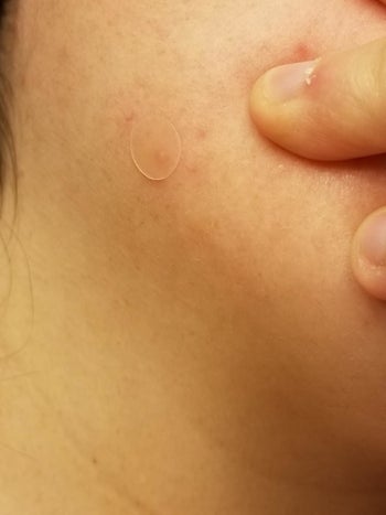 a pimple patch on a reviewer's cheek